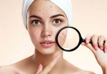 6 tips για να αποφύγεις την ακμή